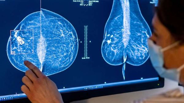 Jede Minuten erhalten vier Frauen, über die Welt verteilt, die Diagnose Brustkrebs und jede Minuten stirbt eine Frau daran. Diese Zahlen könnten in Zukunft noch steigen.
